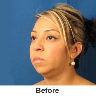 Chin Implants - Before - Patient 1a