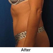 Liposuction - After - Patient 1a