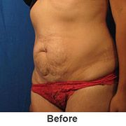 Liposuction - Before - Patient 1a