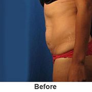 Liposuction - Before - Patient 1a