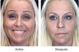 Before and After Botox Photos