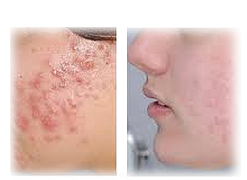  Clarity Treatment Results