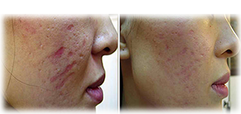 dermapen Treatment