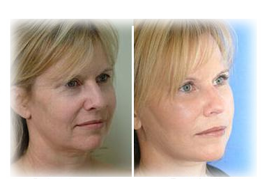  Opulence Treatment Results