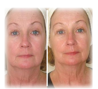 Rejuvenate Treatment