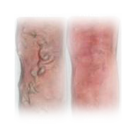 Vein Reduction