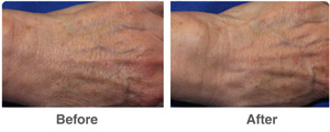 Before and After Laser Skin Therapy