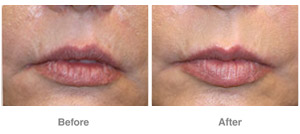 Before and After Dermal Filler