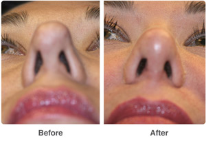 Before and After Rhinoplasty