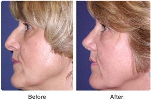 Before and After Rhinoplasty