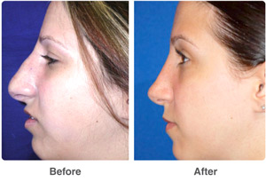 Before and After Rhinoplasty