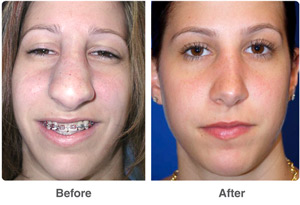 Before and After Rhinoplasty