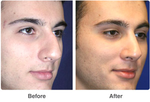 Before and After Rhinoplasty