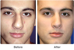 Before and After Rhinoplasty
