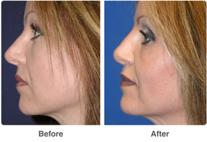 Before and After Rhinoplasty