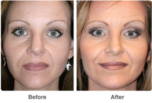 Before and After Rhinoplasty