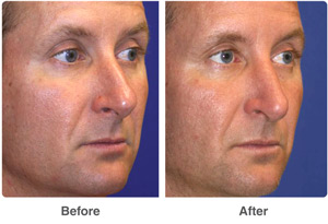 Before and After Rhinoplasty