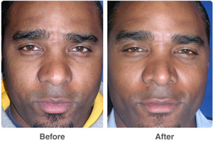 Before and After Rhinoplasty