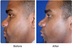 Before and After Rhinoplasty