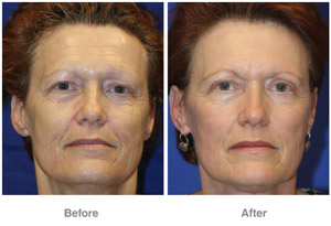 Before and After Laser Skin Therapy
