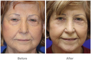 Before and After Laser Skin Therapy