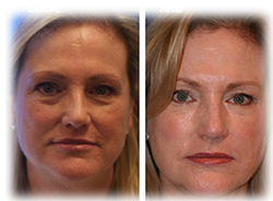 Before-and-After Vampire FaceLift