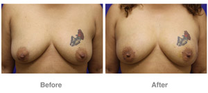 Breast Fat Grafting