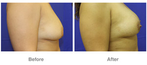 Breast Fat Grafting