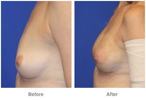 Breast Fat Grafting