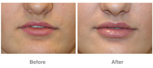 Before and After Dermal Filler