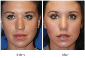 Before and After Rhinoplasty
