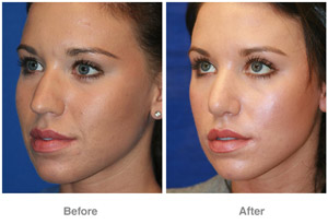 Before and After Rhinoplasty