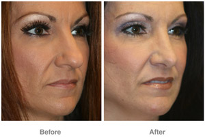 Before and After Rhinoplasty