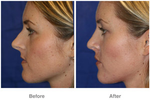 Before and After Rhinoplasty
