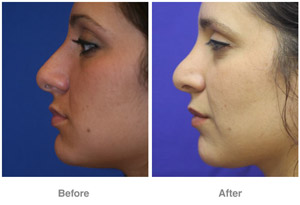 Before and After Rhinoplasty