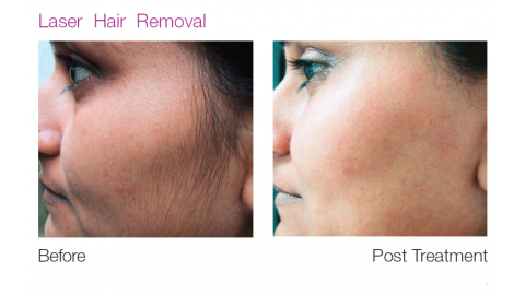 Laser Hair Removal - Patient 1