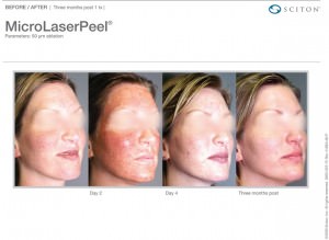 micropeel sciton before and after corona-ca