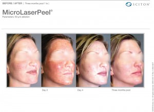 micropeel by sciton_before & -after corona-ca