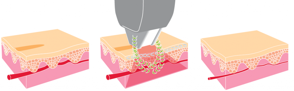 elos vein removal corona, ca