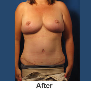 Abdominoplasty - After - Patient 1a
