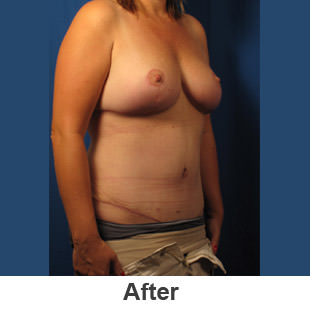Abdominoplasty - After - Patient 1a