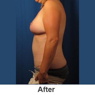 Abdominoplasty - After - Patient 1a