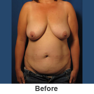 Abdominoplasty - Before - Patient 1a