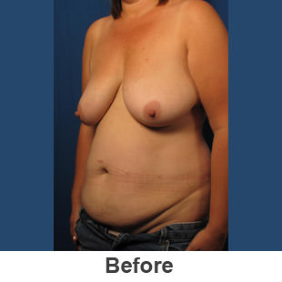 Abdominoplasty - Before - Patient 1a