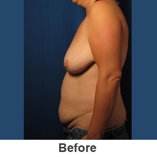 Abdominoplasty - Before - Patient 1a
