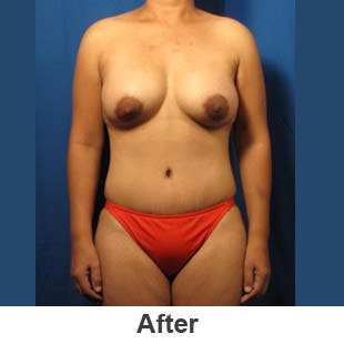 Breast Augmentation - After - Patient 1a