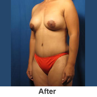 Breast Augmentation - After - Patient 1a