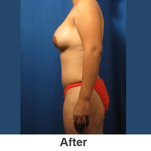 Breast Augmentation - After - Patient 1a