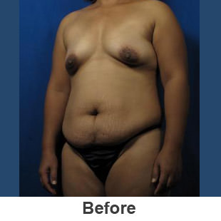 Breast Augmentation - Before - Patient 1a