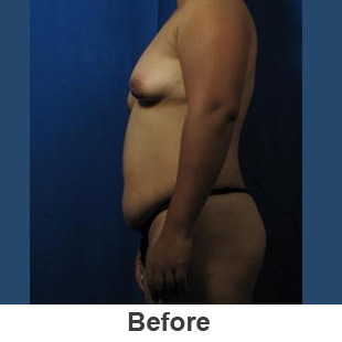 Breast Augmentation - Before - Patient 1a